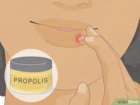 Image titled Get Rid of a Cold Sore Fast Step 10