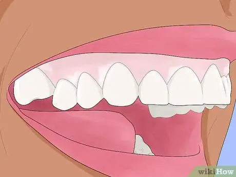 Image titled Treat White Gums Step 2