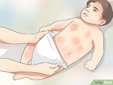 Image titled Cure Impetigo Step 2