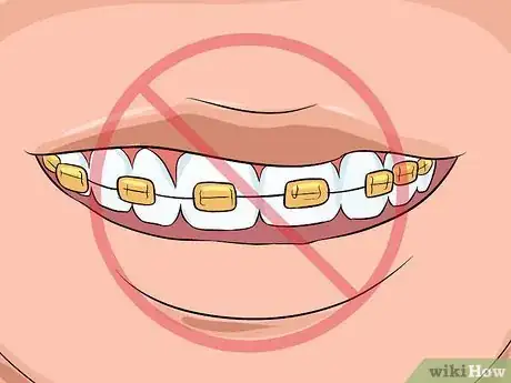 Image titled Choose the Color of Your Braces Step 14