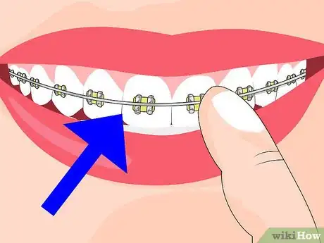 Image titled Avoid Getting Canker Sores Step 4