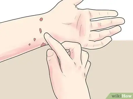 Image titled Kill Scabies At Home Step 17