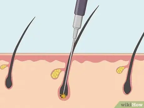 Image titled Remove Pubic Hair Permanently Step 1