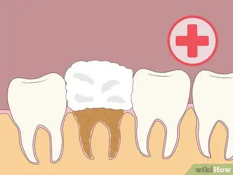 Image titled Prevent Dry Socket After a Tooth Extraction Step 10