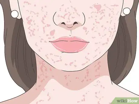 Image titled Treat a Heat Rash on Your Face Step 1