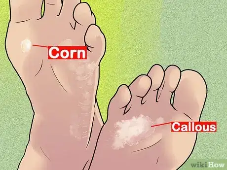 Image titled Know if You Have Corns Step 2