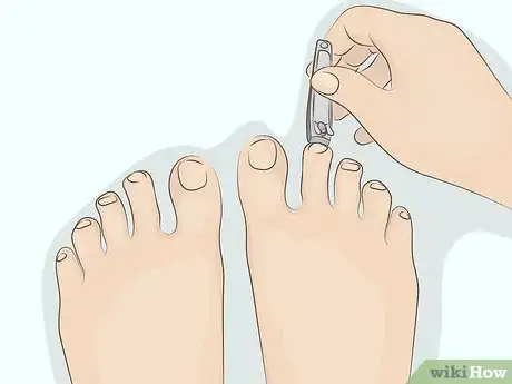 Image titled Cure Onycholysis Step 15