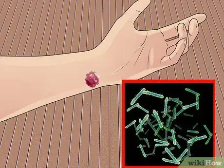 Image titled Recognize Skin Bacterial Infections Step 5