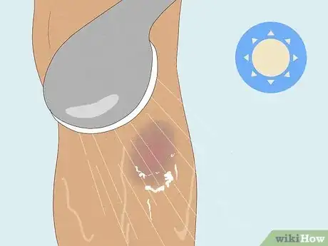 Image titled Get Rid of Bruises with Toothpaste Step 6