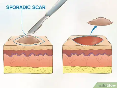 Image titled Get Rid of Acne Scars on Your Chest Step 8