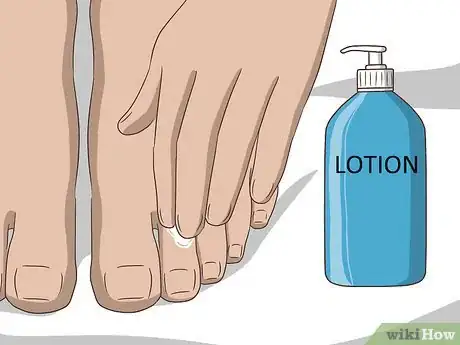 Image titled Get Rid of Chilblains Step 11