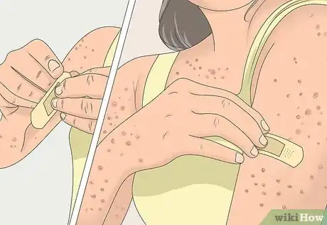 Image titled Prevent Chicken Pox Scars Step 10