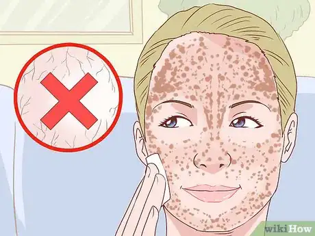 Image titled Treat Acne (Teenage Girls) Step 4