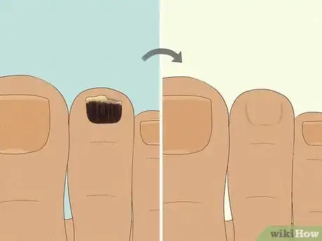 Image titled Treat a Black Toenail Step 12