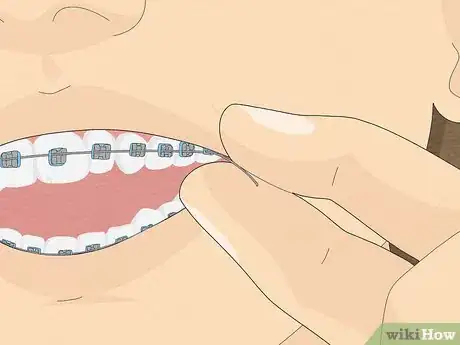 Image titled Temporarily Fix a Loose Wire on Your Braces Step 10