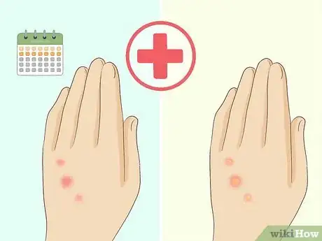 Image titled Treat Bed Bug Bites Step 12