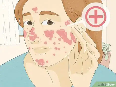 Image titled Tell Eczema from Butterfly Rash Step 4