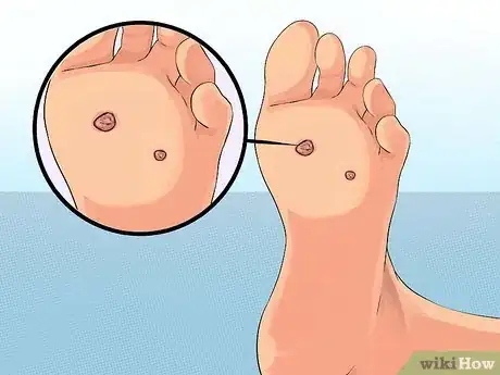 Image titled Get Rid of Plantar Warts (Verrucas) Step 13