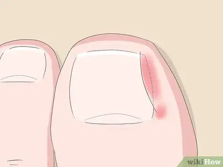 Image titled Relieve Ingrown Toe Nail Pain Step 3