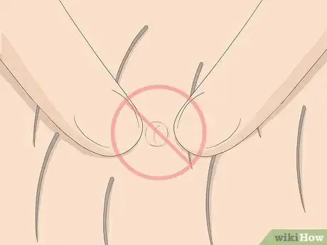 Image titled Get Rid of Ingrown Pubic Hair Step 2