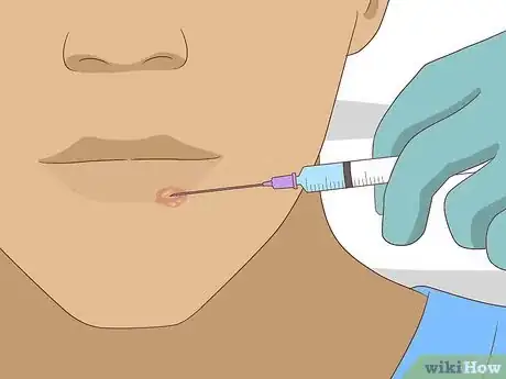 Image titled Get Rid of a Cold Sore Step 11