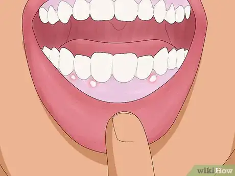 Image titled Treat White Gums Step 11