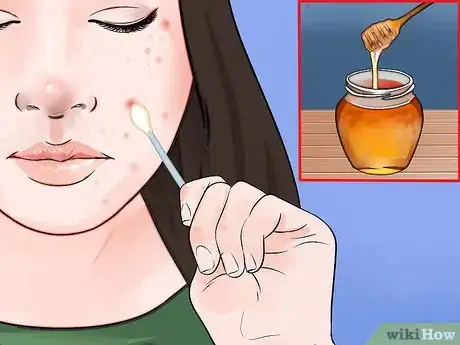 Image titled Remove Ingrown Hair on Your Face Step 5