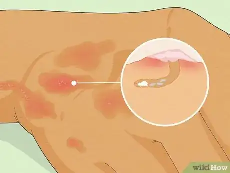 Image titled Recognize Scabies Rash Step 7