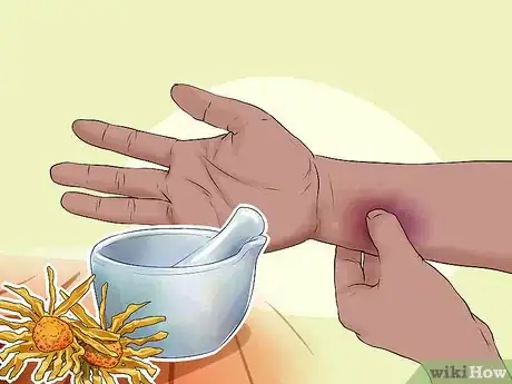 Image titled Use Herbs for Sprains and Bruises Step 1