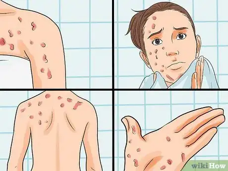 Image titled Identify an HIV Rash Step 2