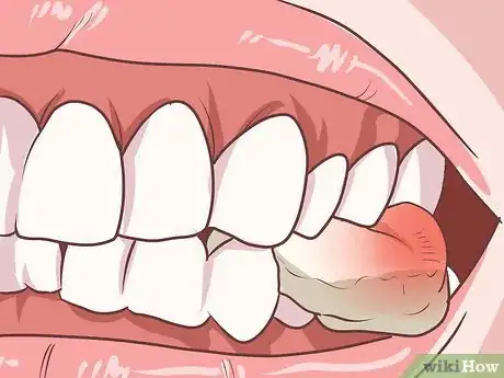 Image titled Prepare for Tooth Extraction Step 16