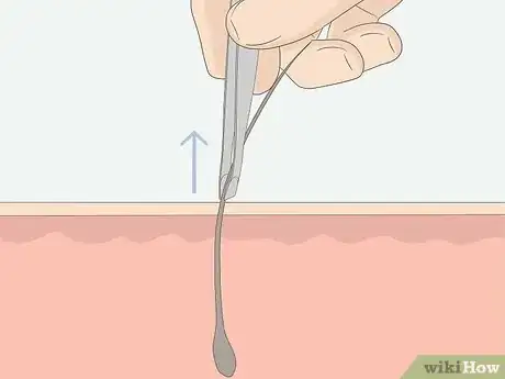 Image titled Get Rid of Ingrown Pubic Hair Step 11