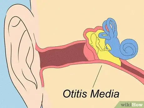 Image titled Differentiate Bacterial Tonsillitis and Viral Tonsillitis Step 9