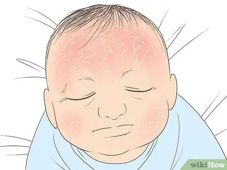 Image titled Know What to Expect on a Newborn's Skin Step 5