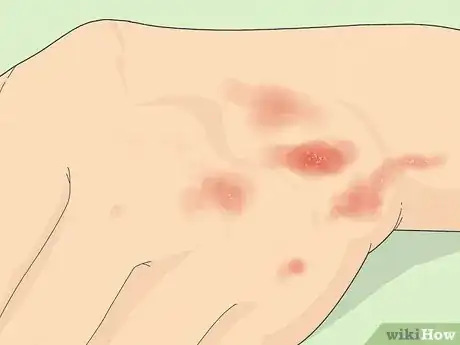 Image titled Recognize Scabies Rash Step 1