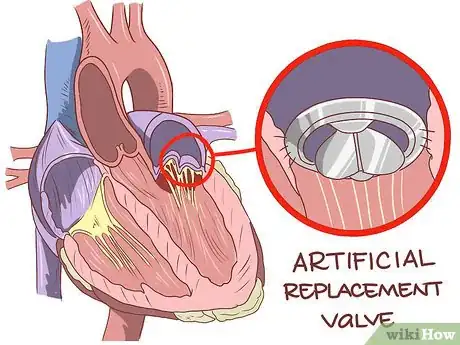 Image titled Treat an Enlarged Heart Step 11