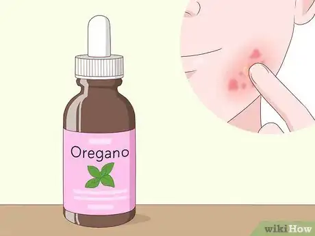 Image titled Treat a Skin Yeast Infection Naturally Step 3