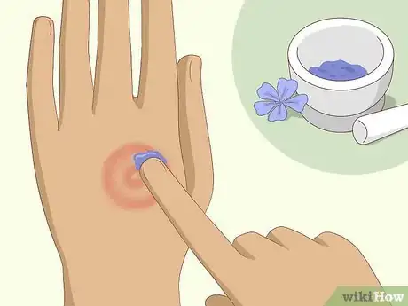 Image titled Get Rid of Ringworm Naturally Step 3