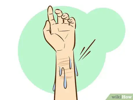 Image titled Get Rid of Self Harm Scars Step 15