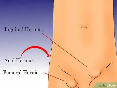 Image titled Check for a Hernia Step 2