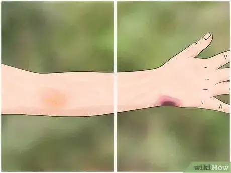 Image titled Identify a Spider Bite Step 4