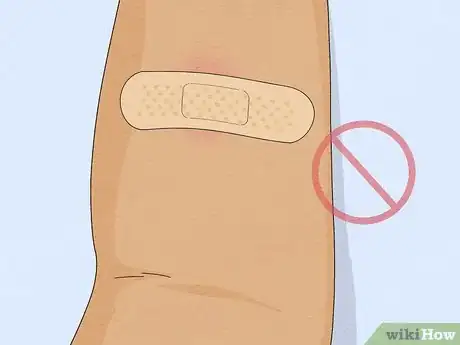 Image titled Properly Place a TB Skin Test Step 17