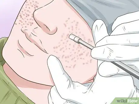 Image titled Erase a Pimple Scar Step 10