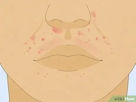 Image titled Treat a Face Rash After Waxing Step 1