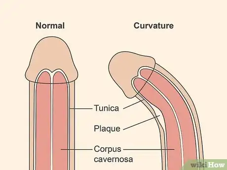 Image titled Treat Peyronie's Disease Step 15