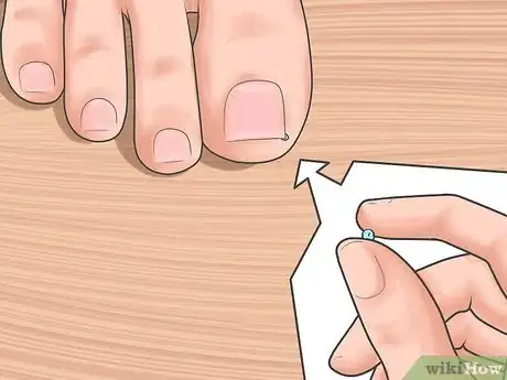 Image titled Tell if You Have an Ingrown Toenail Step 7