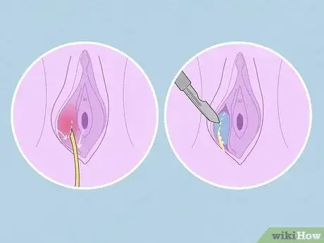 Image titled Treat Vaginal Cysts Step 4