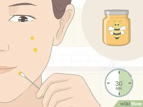 Image titled Get Rid of Acne Redness Fast Step 5