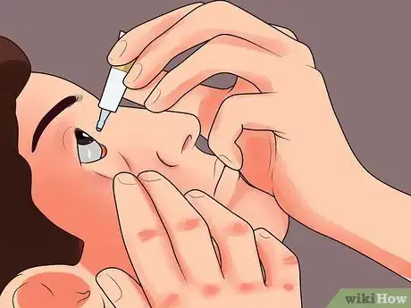 Image titled Use Erythromycin Eye Ointment Step 3