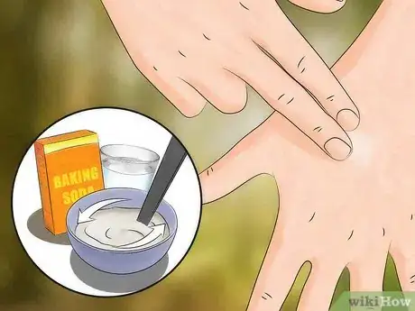 Image titled Get Rid of Bug Bites Step 5